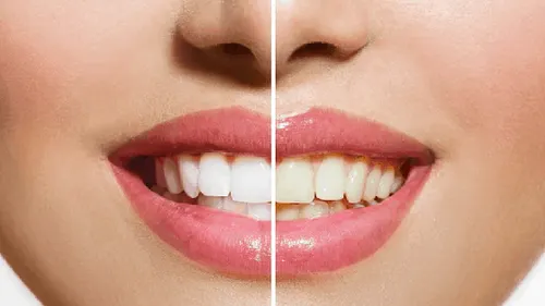 Teeth whitening
