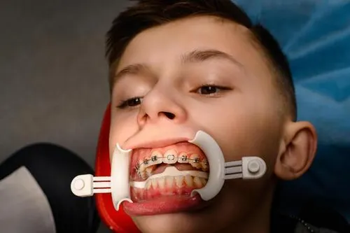 Orthodontics braces